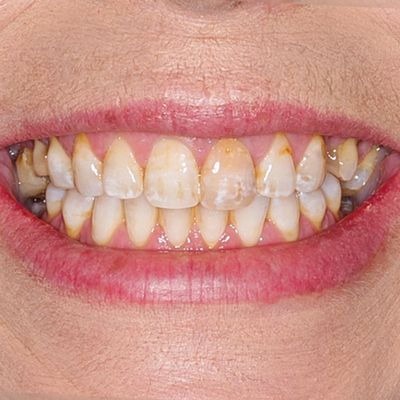 Dental Bonding - Smile 26 before